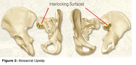 A series of ridges and complementary depressions produces friction and helps interlock the two bones, providing form closure to the SI joint (Fig. 2).