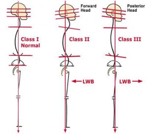 Figure 5: The three most common neck and jaw postural patterns. When comparing Class II and III structures to class I, normal, the line of weight hearing (LWB) falls more posterior to the plumb line in the Class II, retrusive jaw. (exterior-dominant neck) and anterior in the Class III, protrusive jaw (flexor-dominance neck). Class II presents with hyperlordotic neck with the apex peaking at about C4-5, C5-6… the two most common areas of disc herniation in the cervical spine The Class II subject is also likely to experience TMJ dysfunction as the mandible is crammed into the condyles. 