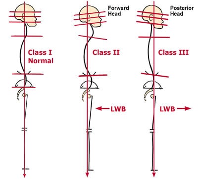 Figure 3: Neck and jaw postural patterns. Any alteration in head/neck/thorax symmetry also profoundly affects jaw alignment. When comparing Class II and HI deviated postures to Class I, Normal, notice how the line of weight bearing falls posterior to the plum line in Class II (retrusives) and anterior in Class III (protrusives). Class IIs frequently experience TMJ dysfunction as the mandibular condyles and disc are crammed into the fossa. Adapted from Ross Pope with permission, 2003.