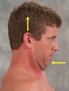 Figure 3: Chin-tucking exercise. Client is instructed to tuck his chin while attempting to rid his head toward the ceiling in a count of three, and then relax. Repeat this maneuver 10 times, twice a day to strengthen longus capitis/coli.