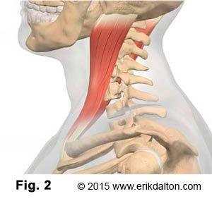 Sensing the longus capitis muscles can no longer carry out their duty as primary head-on-neck flexors, the brain calls on the powerful sternocleidomastoids (SCMs) as pinch-hitters (Fig. 2).