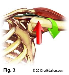 Postural overdevelopment of these muscles creates a deltoid shear (crossing of rotator cuff under AC joint), leading to shoulder impingement, tendinitis and bursitis syndromes (Fig. 3).