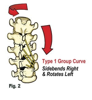 Technically, a functional scoliosis must consist of three or more adjoining vertebrae that rotate to one side and sidebend to the opposite side (Fig. 2).