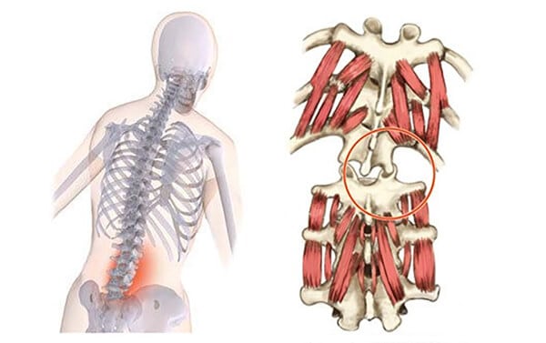 Musculus Multifidus