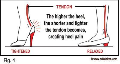 Ongoing use of high heels will cause a shortened and contractured achilles tendon.