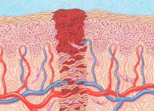 Fig. 2: Illustration of a wound as it is healing. Note the epidermis and dermis with the blood clot.