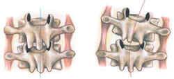 Facet joints stuck closed on right during flexion efforts