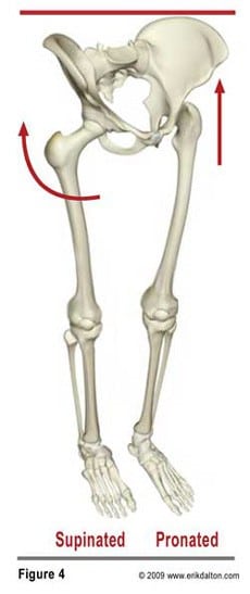 In my experience, the most overlooked and least appreciated area of compensation arises as the femoral heads become asymmetrically positioned in the acetabula. For example, when the pronated left foot internally rotates the thigh and the supinated right foot externally rotates the thigh, one would be walking sideways with each step (Fig. 4).