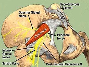 Figure 4. Symptomatic piriformis syndrome. Adapted with permission of Wesley Norman, PhD.