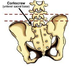 Figure 5. Corkscrew