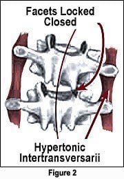 Too often, however, hypertonically SHORT spinal muscles bind one side of a joint altering its axis of rotation and center of gravity (Fig. 2).