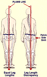 Fig. 12. Cerebral lateralization causes side-shifting over the vestibularly dominant left leg.