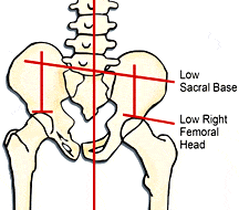 Fig. 3. Low right-femoral head and sacral base with compensatory lumbar scoliosis (sidebent left, rotated right).
