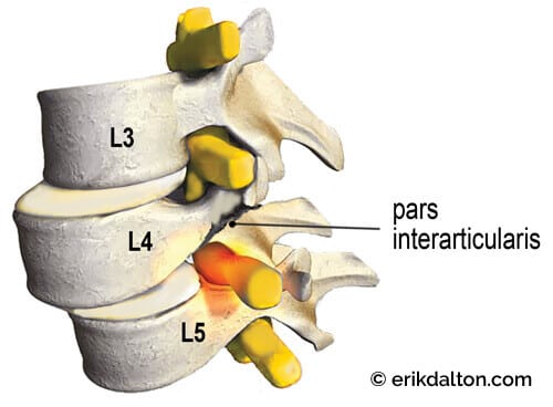 Image 3: Spondylolisthesis - a fracture of the pars interarticularis causes L4 to slip forward on L5, compressing one or both sciatic nerve roots as they leave the spine.