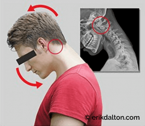 Image 4: O-A joint locked in flexion from text-neck forward head posture.