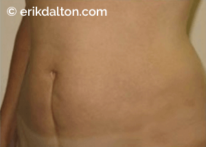 Image 1: The classical Cesarean incision allows for a larger delivery area, but tends to form more adhesions.
