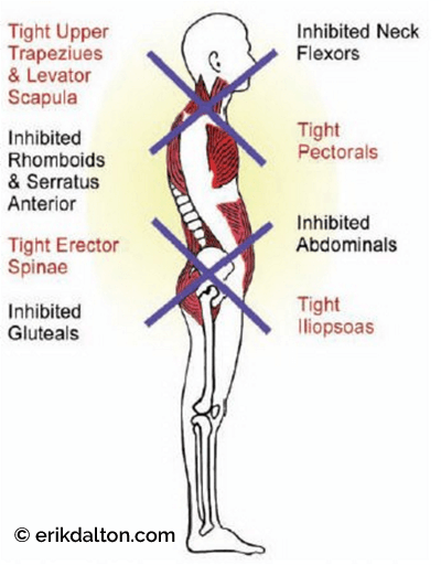 Figure 5: V. Janda’s upper and lower crossed syndromes. Mediclip, Lippincott & Wilkins, 2005 with permission.