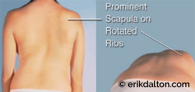 Figure 3: Scoliokyphosis. The above right structure scoliosis is formed by coronal and sagittal plane influences. The ribcage hump becomes more prominent during forward bending. Courtesy of Erik Dalton.