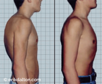 Figure 11: Functional right thoracic scoliosis. The “before” photos show asymmetric positioning of the trunk and back including rounded shoulders, prominent abdomen and forward head posture. Courtesy of Erik Dalton.