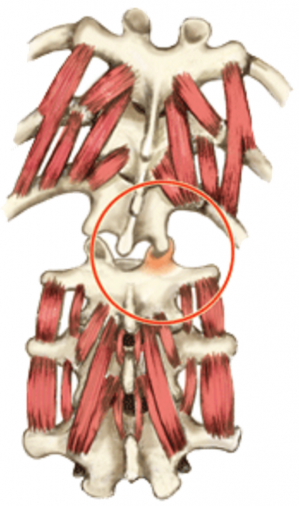 True Grit of Muscle Spasm