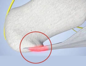 Pain from plantar fasciitis can sometimes cause more than just discomfort.