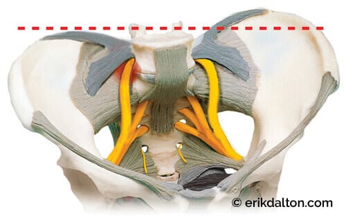 Image 5: A torsioned pelvic bowl causes the anterior iliolumbar ligaments to entrap a branch of the sciatic nerve.