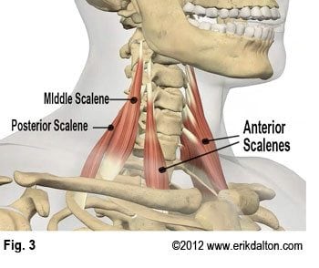 Cervical nerves and vessels often become trapped between fibrotic anterior and middle scalene tendons as they enter the thoracic inlet (Fig. 3).