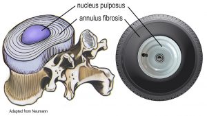 Image 3: The annulus resembles a radial tire encapsulating the (hubcap) nucleus.