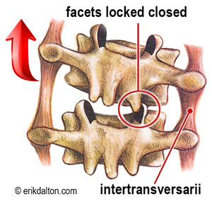 Image 3. Intertransversarii muscle spasm prevents facets on the right from gliding open during forward bending.