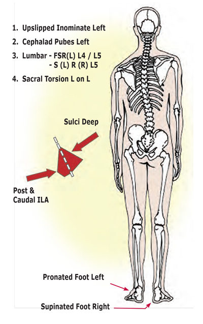 Figure 13: Common functional scoliotic pattern. The right arch attempts supination in an effort to level the ilia, but is unsuccessful as the pelvic bowl side-shifts over the left femur and up-slipped left ilium.