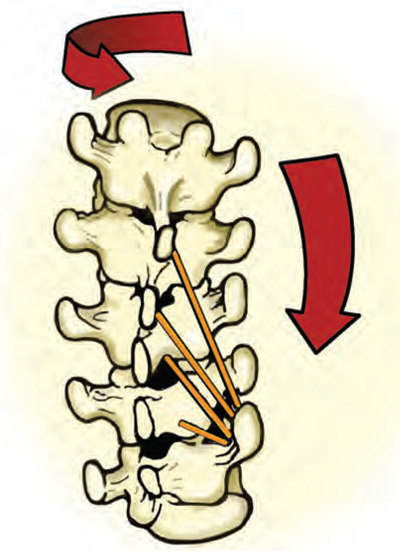Figure 14: Type I group curve. When three or more consecutive vertebrae bend to one side and rotate in the opposite direction, osteopaths label this a “type1 group curve” or functional scoliosis.