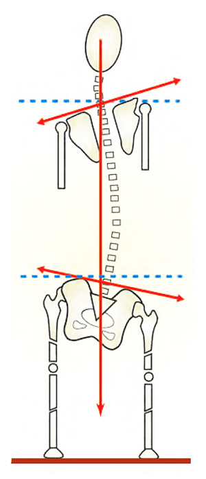 Figure 15: Scoliosis and the short leg syndrome. Long C-shaped scoliotic patterns from short leg syndromes arise from psoas imbalance, sciatic irritability healed leg fracture, hyperpronation, unloved hip prothesis etc.