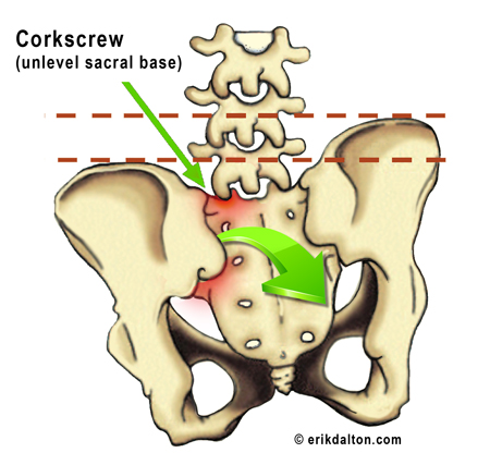 Fig. 12 - Corkscrew