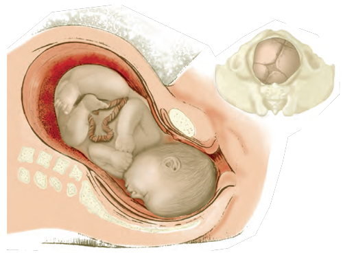 Figure 2: In the left fetal lie configuration, the baby’s head is inferior, flexed and rotated left with arms and legs curled to accommodate restrictions in the uterine cavity. Adapted from Bill Allen with permission.