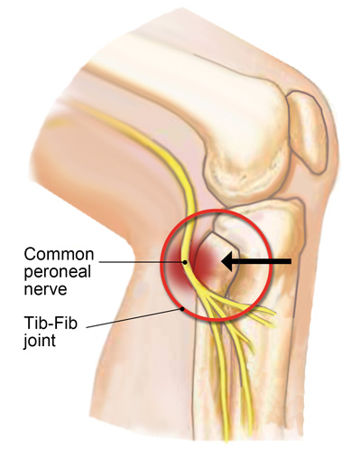 Image 4. Common peroneal nerve impingement due to a posteriorly fixated fibular head