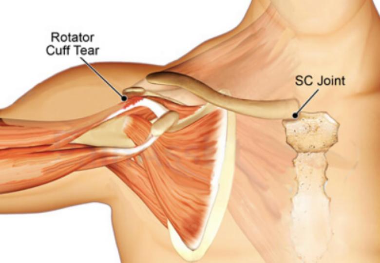 Разрыв манжеты плечевого. Ротаторная манжета плечевого сустава анатомия. Ротаторная манжета плечевого сустава разрыв. Артрит грудино ключичного сустава. Мышцы ротаторной манжеты плечевого сустава.