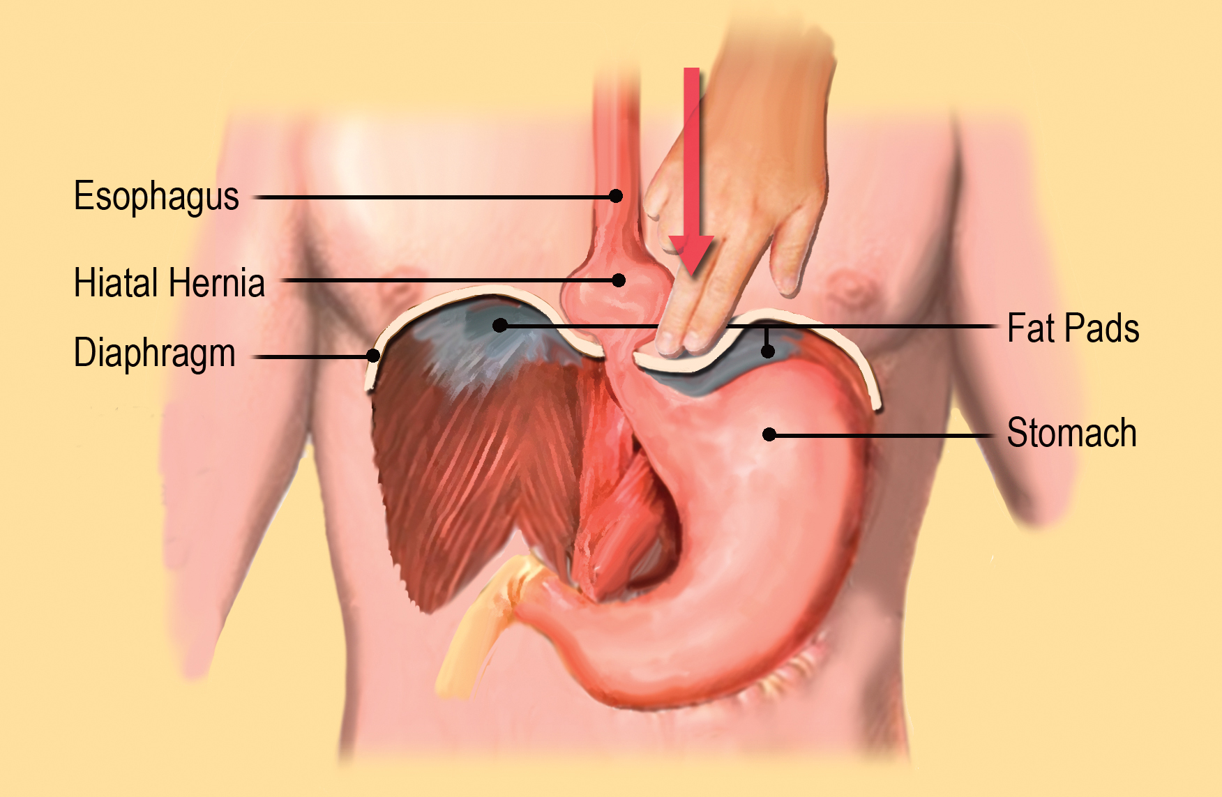 Hiatal Hernia, Acid Reflux and GERD, image size:1752x1143