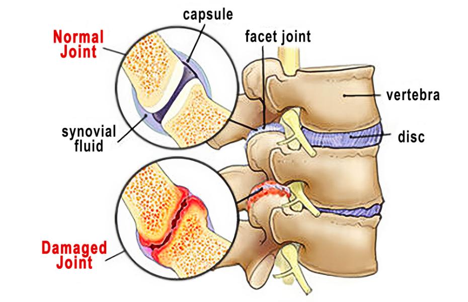 Image 1. Z-joint Pathology: Mechanical wear and tear of the zygapophyseal (Z-joints)