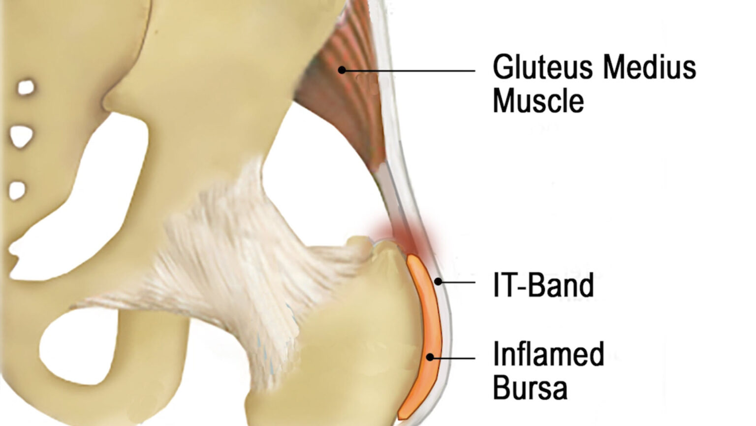 Greater Trochanteric Pain Syndrome A Massage Therapist s Guide To Hip 
