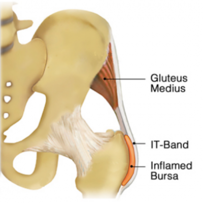Lateral-HipPain-Greater Trochanteric Pain Syndrome with inflamed bursa-Blog-780x540