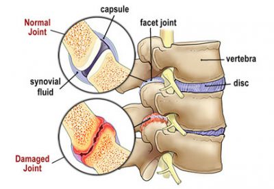 Image 1. Z-joint Pathology: Mechanical wear and tear of the zygapophyseal (Z-joints)